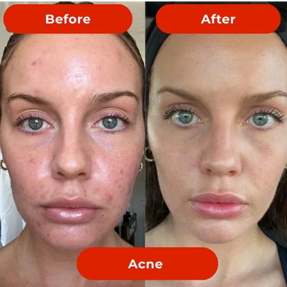 LED Light Therapy Face Mask-The #1 Trusted For Skin Rejuvenation